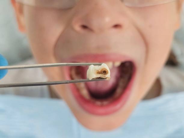Best Emergency Dental Care for Broken or Chipped Teeth in Roy, UT
