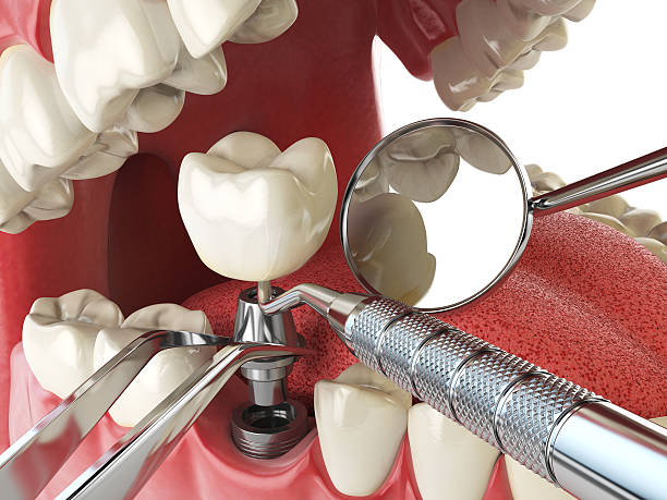 Best Emergency Tooth Extraction in Roy, UT
